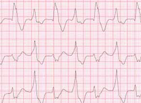 New Data analysis estimates Heart attack risk