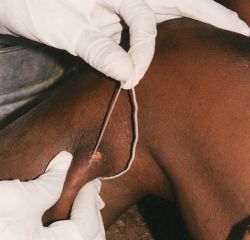 Guinea worm disease – cure without modern medicine