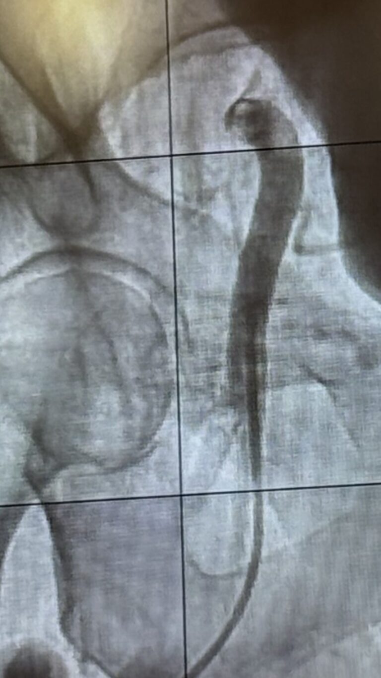 Denervation for hypertension
