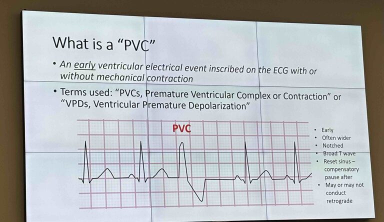 Premature ventricular complex
